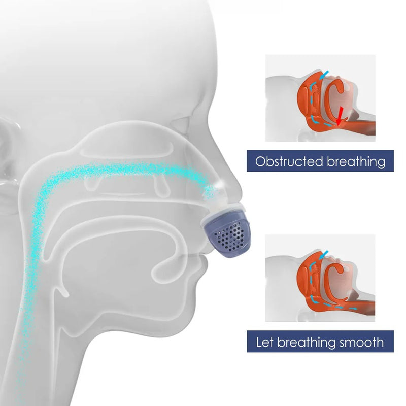BreaFix Anti-Snoring Device